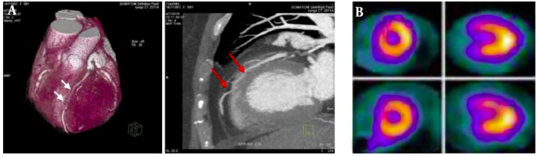 Diagnostic ability of 384-slice computed tomographic angiography in ...