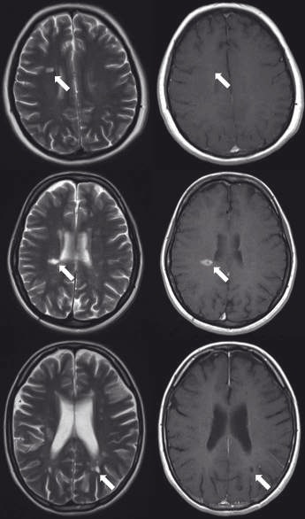 Quantitative Mri Texture Analysis In Differentiating Enhancing And Non Enhancing T1 Hypointense